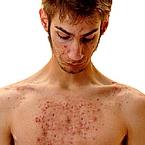 chest wall acne