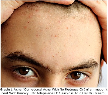 Grade 1 Acne & Best Treatment Option