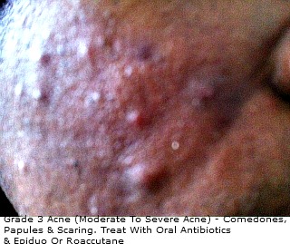 Grade 3 Acne: Papules, Pustules, And Scars!