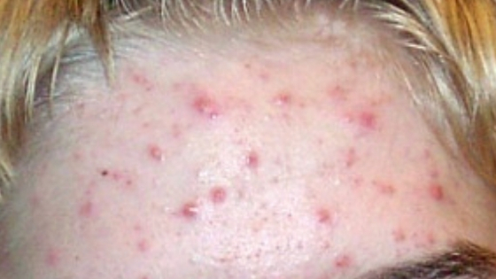 acne in a young man forehead