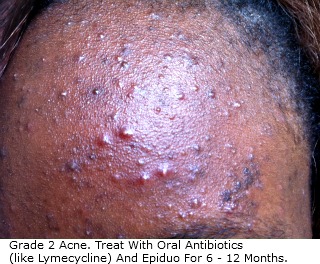 Grade 2 Acne & Best Treatment Options