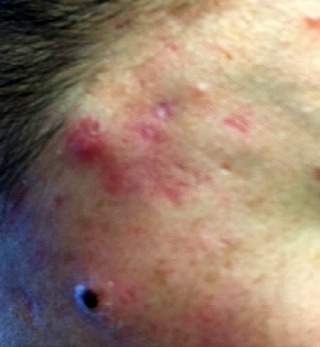 acne-scars.jpg