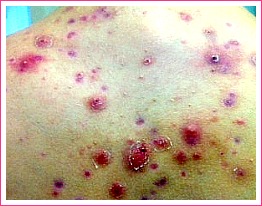 adult cystic acne