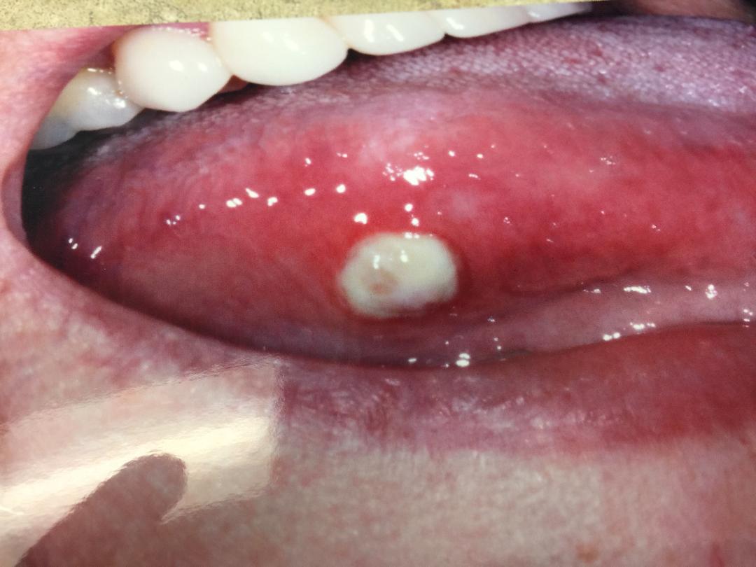 Canker Sore On The Tongue Picture And Treatment DrEdemacom.