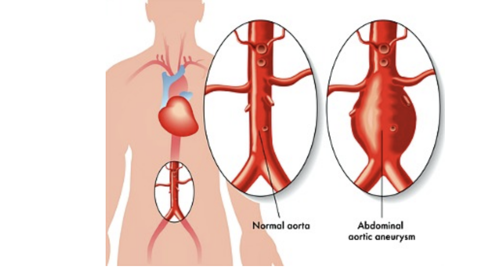 Abdominal aortic aneurysm symptoms This is what your aorta looks like