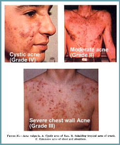 types of acne